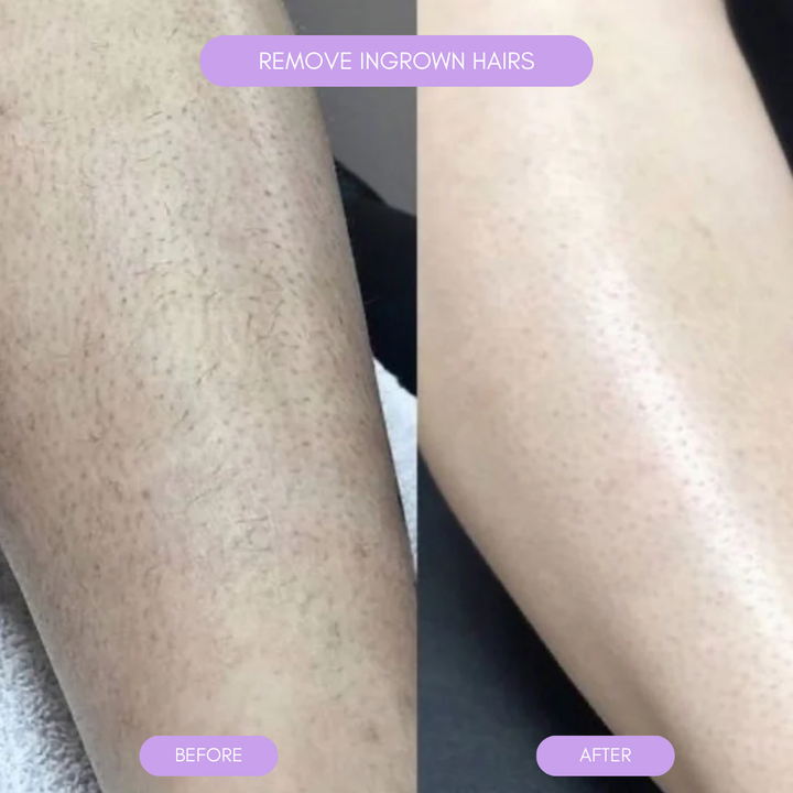 BowLift | Hair removal device for smooth soft skin