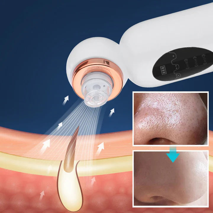 BowLift | Blackhead Remover and Hydrodermabrasion Device