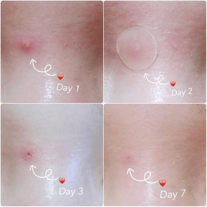 BowLift | Skin Tag and Acne Patch