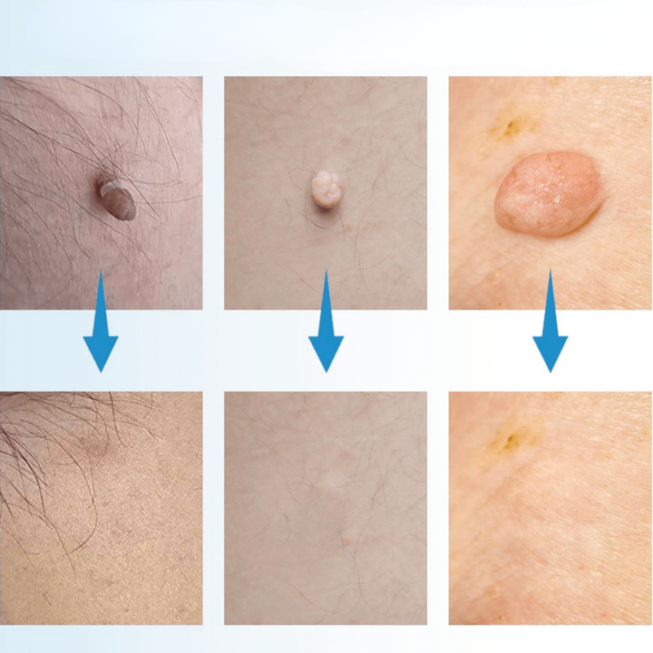 BowLift | WartAway – Remove warts, completely without chemicals!