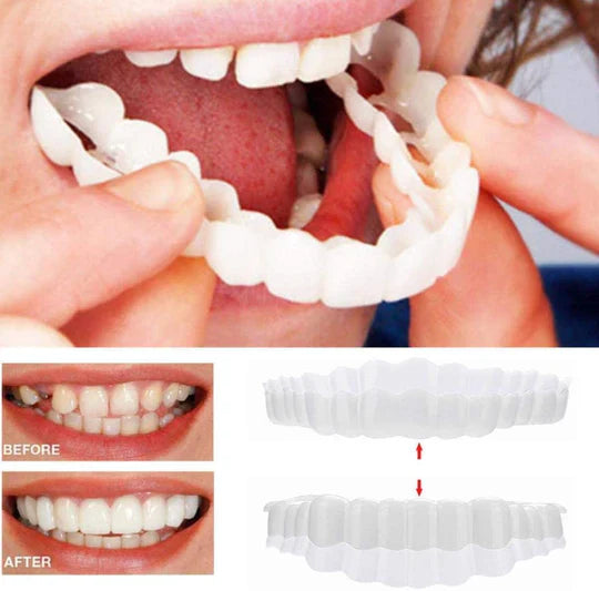 BowLift | Smile Veneer (Upper & Lower Included)
