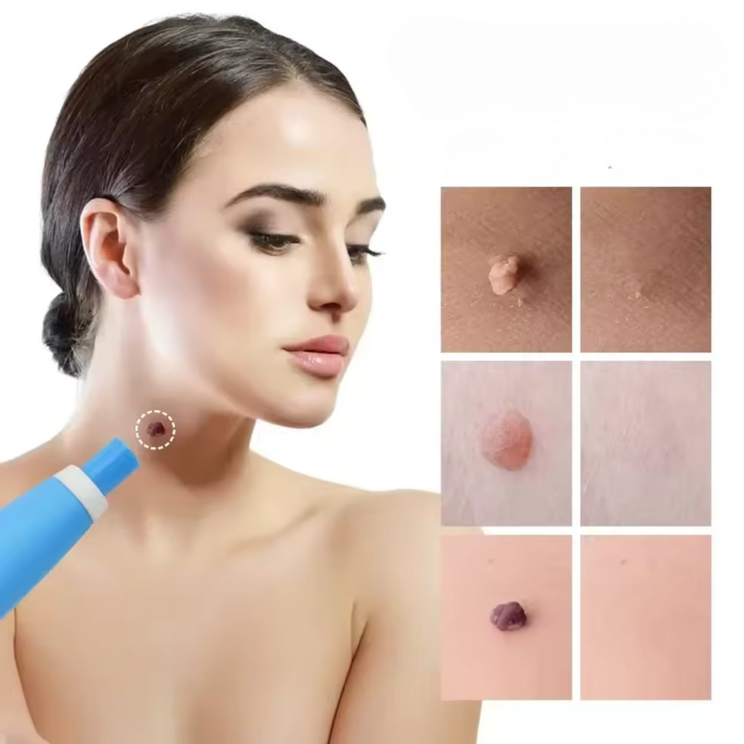 BowLift | WartAway – Remove warts, completely without chemicals!