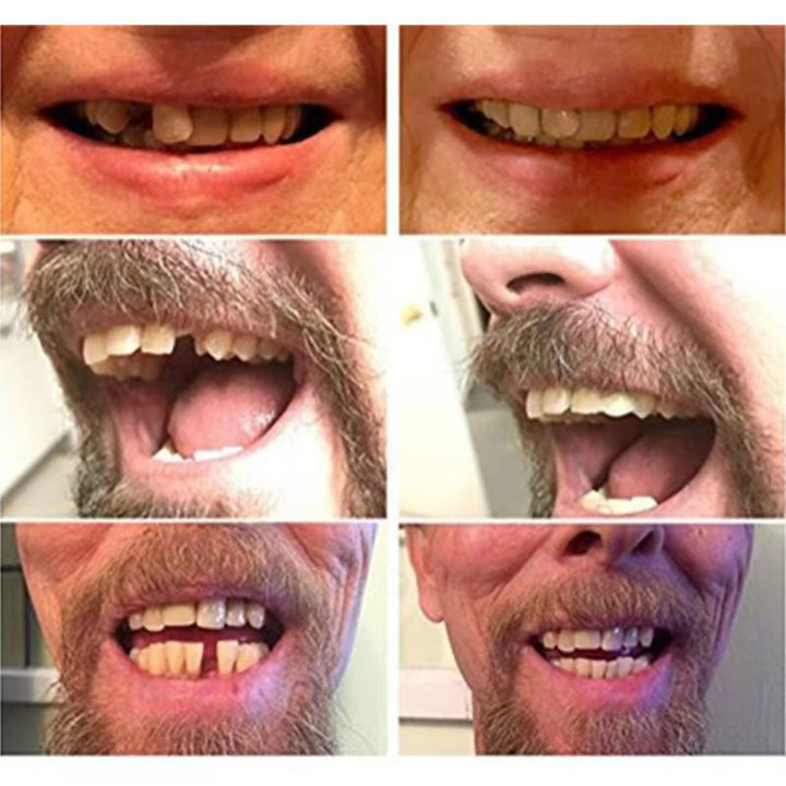 BowLift | High-quality false teeth