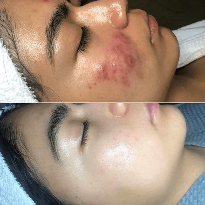BowLift | High-Frequency Skin Therapy Device