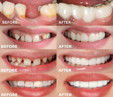 BowLift | Click-In Dental Prosthesis | 1+1 FREE!