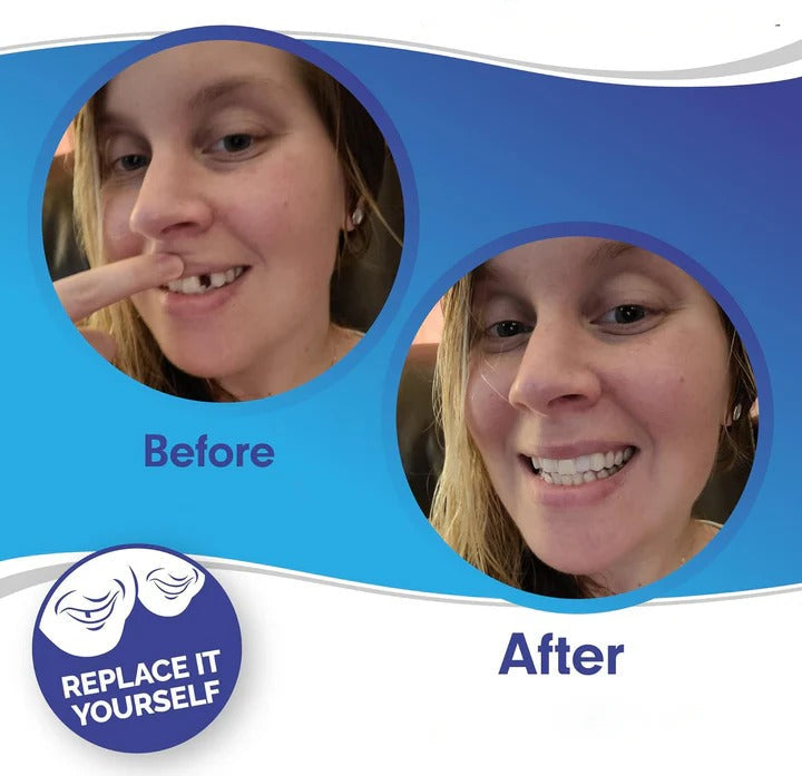 BowLift | Removable Smile Veneers for Upper and Lower Teeth