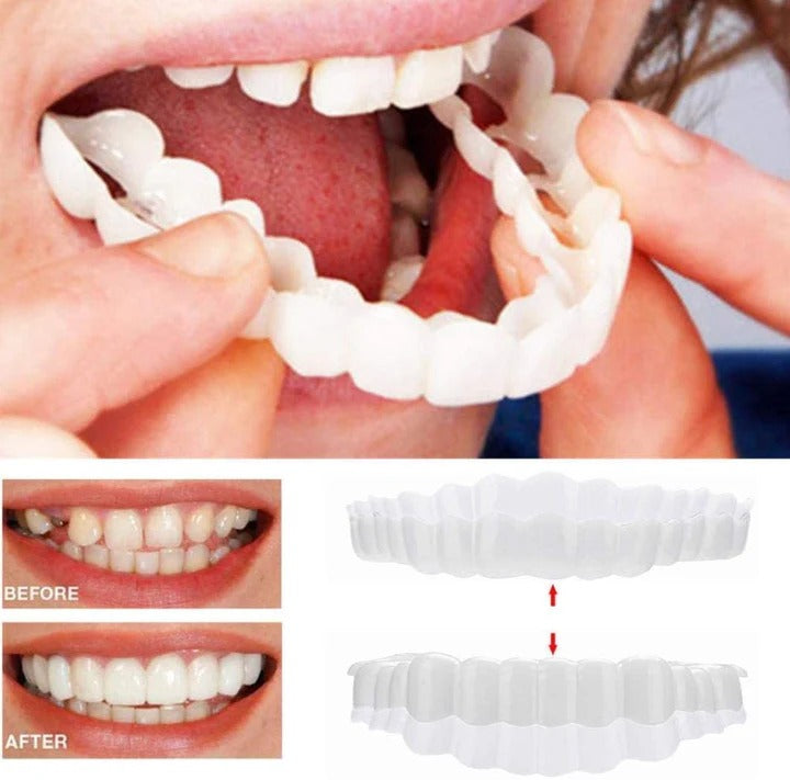 BowLift | Removable Smile Veneers for Upper and Lower Teeth